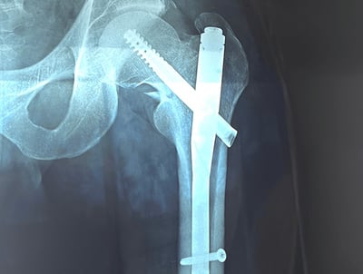 Anteroposterior Radiograph of the Left Femur Post-Internal Fixation with Osteosynthesis