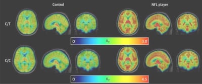 Study on Concussion Affects in NFL Players