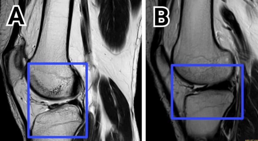 ACLR Study Results