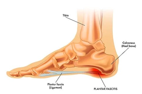 Plantar fasciitis study